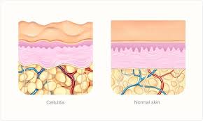 Urgent imaging and surgical consultation (ent and ophthalmology) should be considered for any child with suspected orbital cellulitis. What Is Cellulitis
