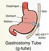 Changing A G Tube Gastric Feeding Tube Gastrostomy Tube Feeding Tube Awareness Feeding Tube