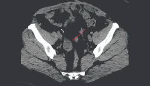 Unusual Use Of Radiation Therapy For Pelvic Pain Clinical Advisor