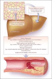 Risk Of Cardiovascular Disease In Patients With Nonalcoholic Fatty Liver Disease Nejm