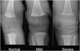 Parathyroid Hormone As A Marker For Metabolic Bone Disease Of Prematurity Journal Of Perinatology