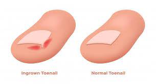 Medical treatment of ingrown toenails. How To Prevent Ingrown Toenails Elliott M Perel Dpm Facfas Podiatrist
