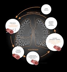 Image result for Bronchiectasis