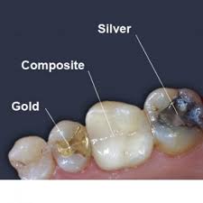 A composite filling is becoming the standard for cavity treatment, and here's why. White Fillings Headington Composite Fillings Oxford Crowns Cowley