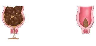 Image result for Functional Encopresis