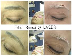 Pin On Laser Tattoo Removal With Ana Maria Margineanu Master Trainer
