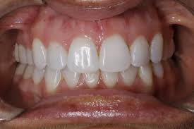 7 Signs Your Child May Need Interceptive Orthodontics Care