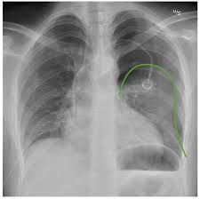 The degree of collapse determines the clinical presentation of pneumothorax. Pneumothorax Concise Medical Knowledge
