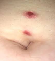 Got Belly Piercing A Month Ago It S A Bit Swollen And Has A Blood Blister Took Top Ball Off To Try To Clean It Better And Piercing Came Out Took This Picture