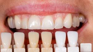 What Are Dental Veneers Read About Types And Costs In This
