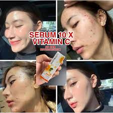 Senarai yang telah dikaji terlebih dahulu! Face Serum Melicinkan Kulit Muka Hilang Jeragat Jerawat 5 Ml Shopee Malaysia