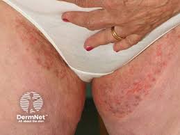 Image result for sore skin in the groin area