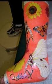 Orthopedic Cast Colors In A Cast Or Have To Have A Cast Put On Your Arm Or Leg Here Are Some Leg Cast Cast Decoration It Cast