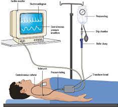 Cvp refects the amount of blood returning to the . Role Of Central Venous Pressure Monitoring In Critical Care Settings