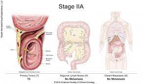 After conducting an array of tests, doctors often assign cancer to one of five stages: Colorectal Cancer Stages Cancer Net