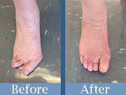 Narrow shoes, hindfoot malalignment and heredity all seem to contribute to the development of bunions, especially in women. Before And After Bunion And Rheumatoid Arthritis Surgery Vegetarian Recipes Healthy Easy Bunion Surgery Bunion