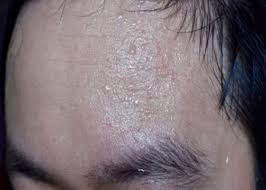 Image result for Anhidrosis