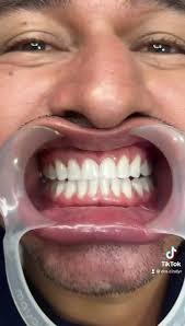 Alineación de bordes dentales con...