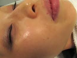 Natural treatments for cherry angioma. My Photofacial Review