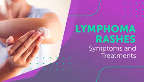 It can look like a: Lymphoma Rashes Symptoms And Treatments Mylymphomateam