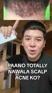 Paano totally nawala scalp acne ko?