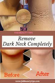 We did not find results for: Get Rid Of Dark Neck In A Week Fab Beauty Tips Dark Skin Around Neck Skin Lightening Diy Dark Spots On Neck