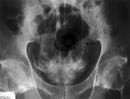 Image result for Voiding Cystourethrogram