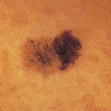 Unfortunately, when it shows up, it is often not recognized. How To Spot Skin Cancer