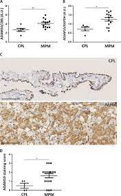 Ascites is a unique form of malignant pleural mesothelioma (mpm) recurrence4. Adam10 Mediates Malignant Pleural Mesothelioma Invasiveness Oncogene