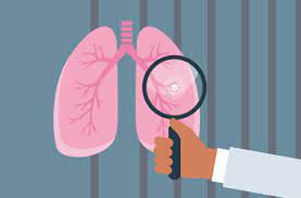 In many cases lung cancer may not show any noticeable symptoms in the early stages. Lung Cancer Screening Do You Need It Cleveland Clinic