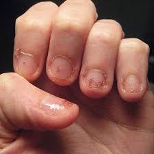 Marginal Notes Biting My Nails