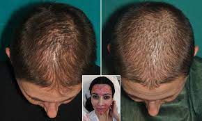 But you don't have to go all interview with a vampire to make use of prp — in fact, there's no biting necessary. Kim Kardashian S Blood Facial Now Transformed To Use Your Blood To Lengthen And Strengthen Locks Daily Mail Online
