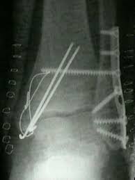 • deformity around the ankle • swelling • heamatoma • bony tenderness • instability and pain on. Medial Malleolar Fractures Wheeless Textbook Of Orthopaedics