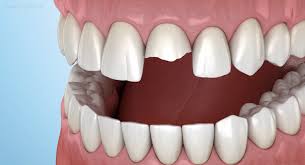 Image result for Tooth Fracture