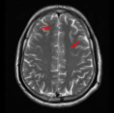 Image result for Progressive Bulbar Paralysis