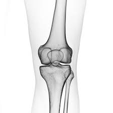 Image result for Knee Dislocation