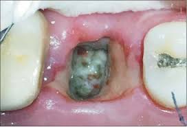 Once your tooth's extraction process has been completed, you'll no doubt want to know how long it will take for its socket to heal. I Recently Had A Tooth Extraction And I M A Smoker But Only Smoke Once A Day Do I Have To Wait The Entire 72 Hours Before Smoking Quora