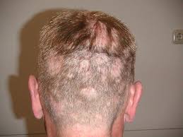 The first recorded outbreak of syphilis in europe occurred in 1494/1495 in naples, italy, during a french invasion. Syfilis Lues Huidarts Com