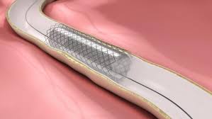 Film de mark lewis et jean guillemet, un aperçu de la vie autrefois, de la solidarité témoin du changement du mode de vie qu'il y eu à la. Stent Actif Ou Nu Comme Se Deroule La Pose D Un Stent