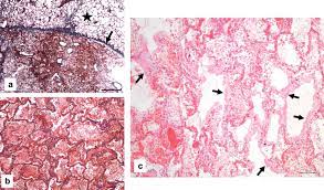 Parenchyma is inhomogeneous during ventilation following the open lung strategy. A Upper Right Lobe Lung Parenchyma Showing Geographical Heterogeneity Download Scientific Diagram