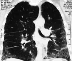 Și tusea tusea neproductivă tusea seacă dacă doriți. Https Pneumologie Usmf Md Sites Default Files Inline Files Indicatii 20metodice 20munteanu 1 Pdf