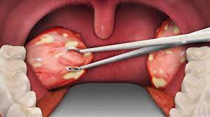 (this inevitably happens in public or while you're on a zoom call, meaning you're both worried about this thing in your throat and you're trying to surreptitiously. Tonsil Removal Surgery Tonsillectomy Surgery Youtube