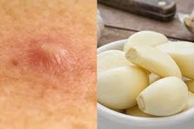Tapi, begini cara mengobati bisul agar cepat. Enggak Perlu Pakai Salep Bisul Bisa Hilang Seketika Cuma Dengan Bawang Putih Begini Cara Pakainya Semua Halaman Sajian Sedap