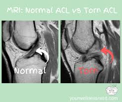 Definitive Acl Injury Guide Is This The True Cause Your Wellness Nerd Normal Acl Mri Vs Torn Acl Mri Mri Acl Aclrec Acl Tear Acl Surgery Acl Recovery