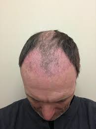 Hair loss, hair thinning and problems with hair growth may occur when your growth cycle is disrupted. Stages Of Hair Transplant Growth See This Patient S Hair Grow After A Transplant