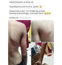 Loratidine adalah antara ubat resdung antihistamin terbaik yang boleh didapati di farmasi. Penyakit Jilat Jin Ini Gegata Rupanya