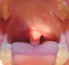 Image result for Uvulitis