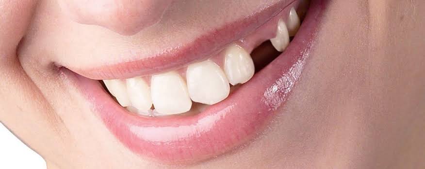 Image result for Restorative Options for a Missing Tooth"