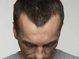 What Can Be Done About A Receding Hairline Hair Restoration Europe