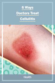 6 Ways Doctors Treat Cellulitis In 2020 Cellulitis Treatment Cellulitis Infection Bacterial Infection